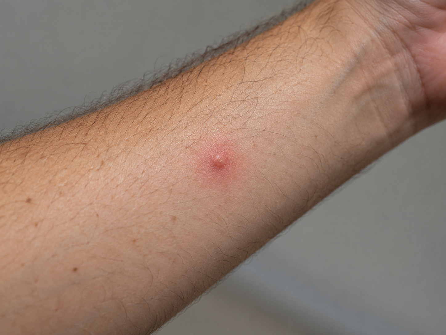 Illustration d'un bouton rouge isolé à sommet clair sur un avant-bras, deux heures après une piqûre de fourmi rouge